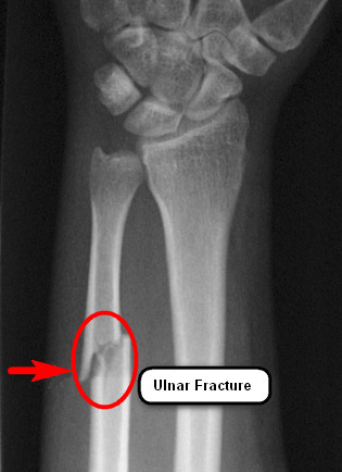 Ulnar-Fracture